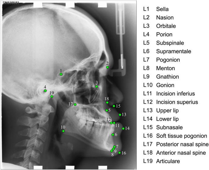 Landmark detection